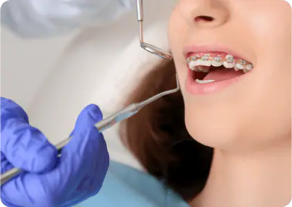 Achieve a picture-perfect smile with the best dental braces services in Dubai.